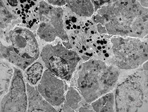 celiakia- infiltration of propria celiakia- infiltration of propria